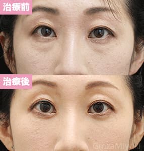 モニター症例№243（37歳 女性）脱脂ダブルリポ