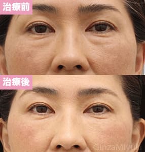 モニター症例№245（49歳 女性）脱脂ダブルリポ