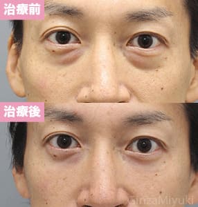 モニター症例№246（40歳 男性）脱脂コンデンスリポ