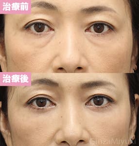 モニター症例№247（46歳 女性）脱脂コンデンスリポ