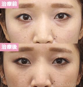 モニター症例№248（33歳 女性）脱脂コンデンスリポ