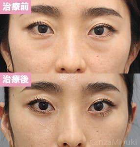 モニター症例№250（33歳 女性）脱脂ダブルリポ