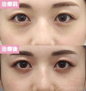 モニター症例№251（31歳 女性）経結膜脱脂