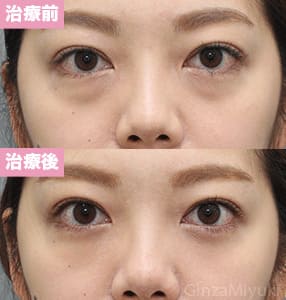 モニター症例№252（32歳 女性）経結膜脱脂