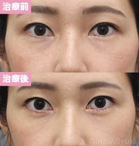 モニター症例№253（33歳 女性）経結膜脱脂