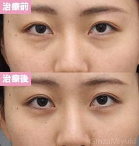 モニター症例№254（21歳 女性）経結膜脱脂