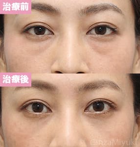 モニター症例№255（35歳 女性）経結膜脱脂