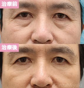 モニター症例№256（59歳 男性）脱脂ダブルリポ