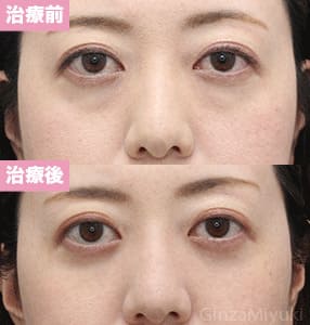 モニター症例№258（35歳 女性）脱脂コンデンスリポ