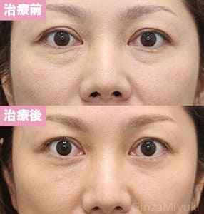 モニター症例№259（42歳 女性）脱脂コンデンスリポ