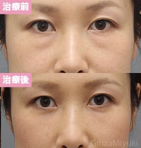 モニター症例№260（37歳 女性）脱脂コンデンスリポ