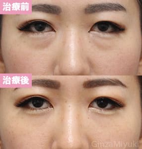 モニター症例№261（29歳 女性）脱脂ダブルリポ