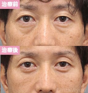 モニター症例№262（48歳 男性）脱脂コンデンスリポ