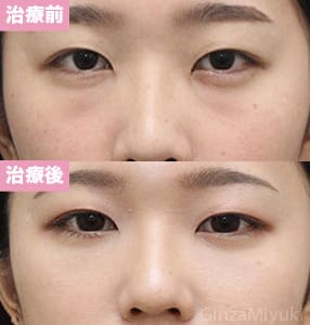 モニター症例№263（26歳 女性）脱脂コンデンスリポ