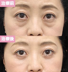 モニター症例№264（53歳 女性）脱脂コンデンスリポ