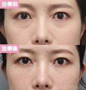 モニター症例№265（38歳 女性）脱脂コンデンスリポ