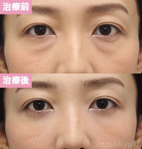 モニター症例№266（32歳 女性）脱脂コンデンスリポ