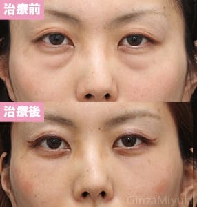 モニター症例№267（35歳 女性）脱脂コンデンスリポ