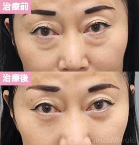 モニター症例№269（60歳 女性）脱脂コンデンスリポ