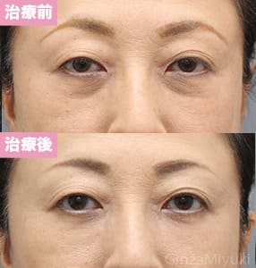 モニター症例№270（58歳 女性）脱脂コンデンスリポ