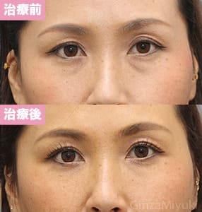 モニター症例№272（38歳 女性）脱脂コンデンスリポ