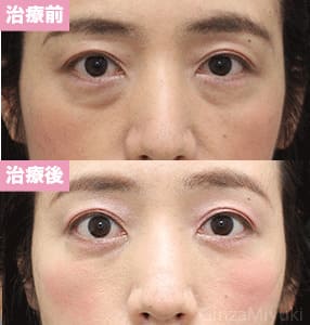 モニター症例№272（43歳 女性）脱脂コンデンスリポ