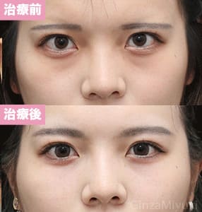 モニター症例№274（20歳 女性）脱脂コンデンスリポ