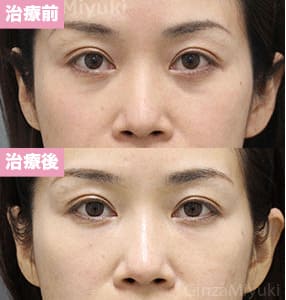 モニター症例№275（44歳 女性）脱脂コンデンスリポ