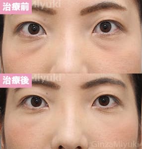 モニター症例№276（30歳 女性）脱脂コンデンスリポ