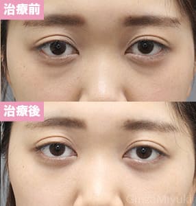 モニター症例№278（27歳 女性）脱脂コンデンスリポ