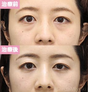 モニター症例№279（31歳 女性）脱脂コンデンスリポ