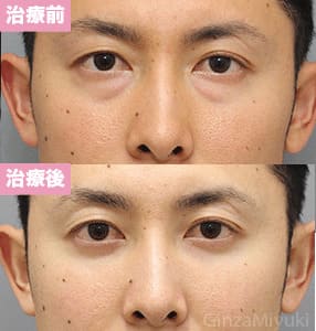 モニター症例№280（33歳 男性）脱脂コンデンスリポ