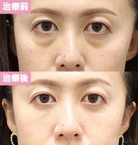 モニター症例№282（38歳 女性）脱脂コンデンスリポ