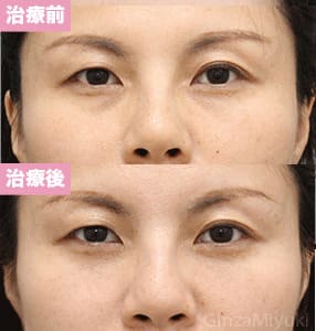 モニター症例№284（40歳 女性）脱脂コンデンスリポ