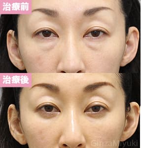 モニター症例№286（43歳 女性）脱脂コンデンスリポ