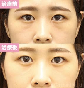 モニター症例№287（30歳 女性）脱脂コンデンスリポ