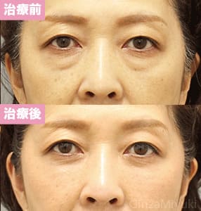 モニター症例№288（56歳 女性）脱脂コンデンスリポ