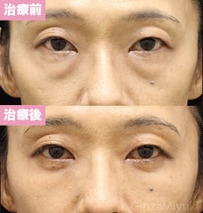 モニター症例№289（52歳 女性）脱脂コンデンスリポ