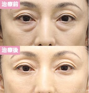 モニター症例№290（47歳 女性）脱脂コンデンスリポ