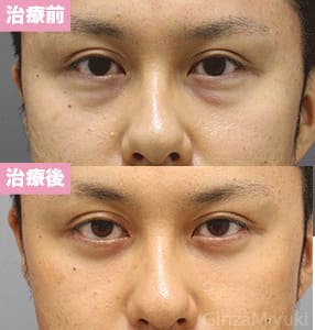 モニター症例№291（34歳 男性）脱脂コンデンスリポ