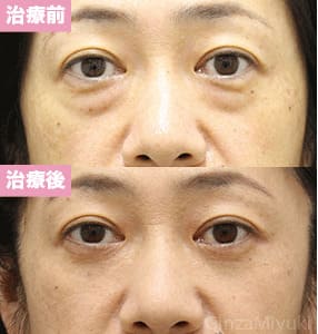 モニター症例№293（50歳 女性）脱脂コンデンスリポ