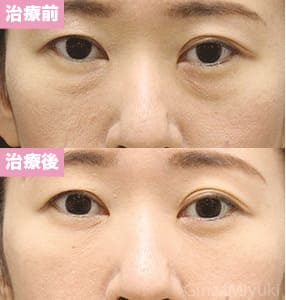 モニター症例№294（44歳 女性）脱脂コンデンスリポ