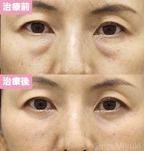 モニター症例№295（52歳 女性）脱脂リポ法