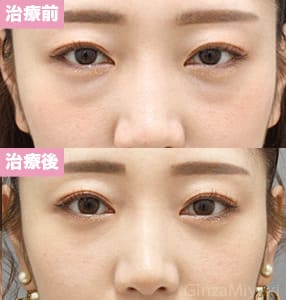 モニター症例№296（25歳 女性）経結膜脱脂