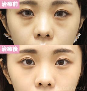 モニター症例№297（23歳 女性）脱脂コンデンスリポ