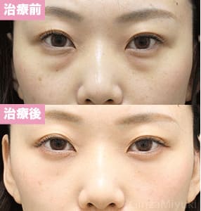 モニター症例№298（23歳 女性）経結膜脱脂