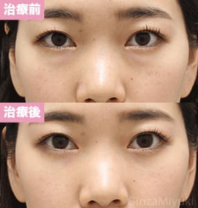 モニター症例№299（29歳 女性）経結膜脱脂