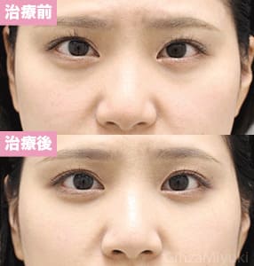 モニター症例№300（28歳 女性）脱脂コンデンスリポ