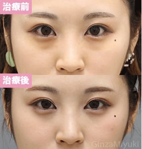 モニター症例№302（21歳 女性）経結膜脱脂