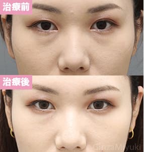 モニター症例№303（27歳 女性）脱脂コンデンスリポ